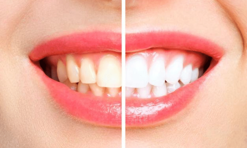 Which Factors Should You Consider When Choosing a Teeth Whitener