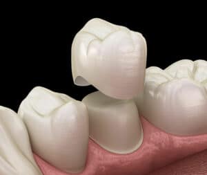 Dental Crown Tempe