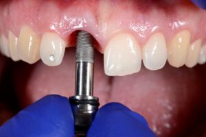 dental implants Tempe at okun dentistry