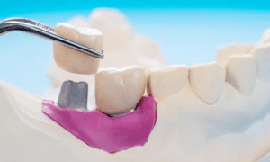 Types of Dental Crowns & How To Choose The Right One For You