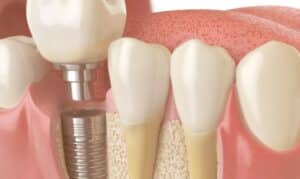 "Patient visits at Okun Dentistry in Tempe, AZ, for Bone Grafting Treatment."