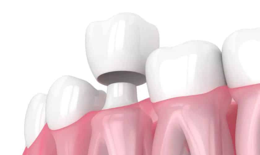 "Patient visits at Okun Dentistry, in Tempe, AZ, for Dental Crowns Treatment."