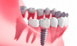 dental implants with this independence day in tempe az
