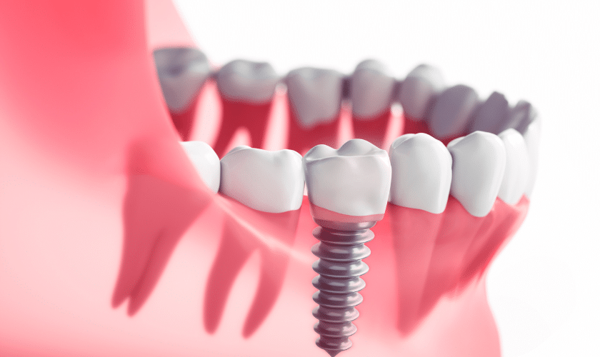 dental implants with this independence day in tempe az