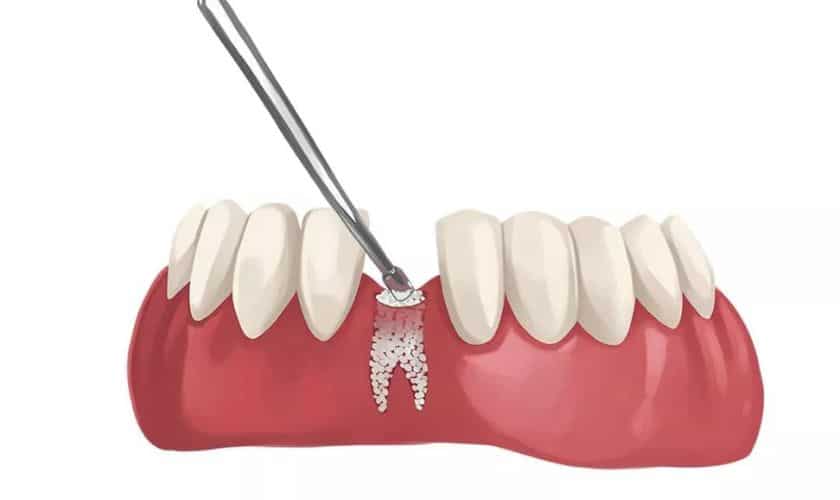 "Patient visits at Okun Dentistry, Tempe, AZ, for Bone Grafting Treatment."