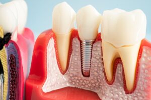 Close-up model of a dental implant showing artificial tooth root integrated into the jawbone next to natural teeth