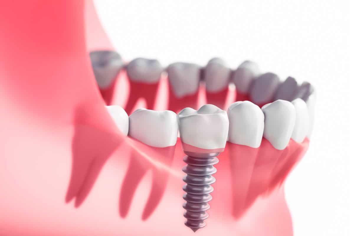 Dental Implants in Round Rock, TX