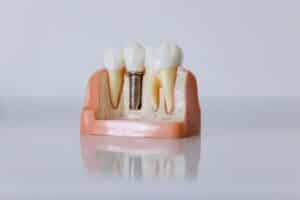 Dental Implants Tempe