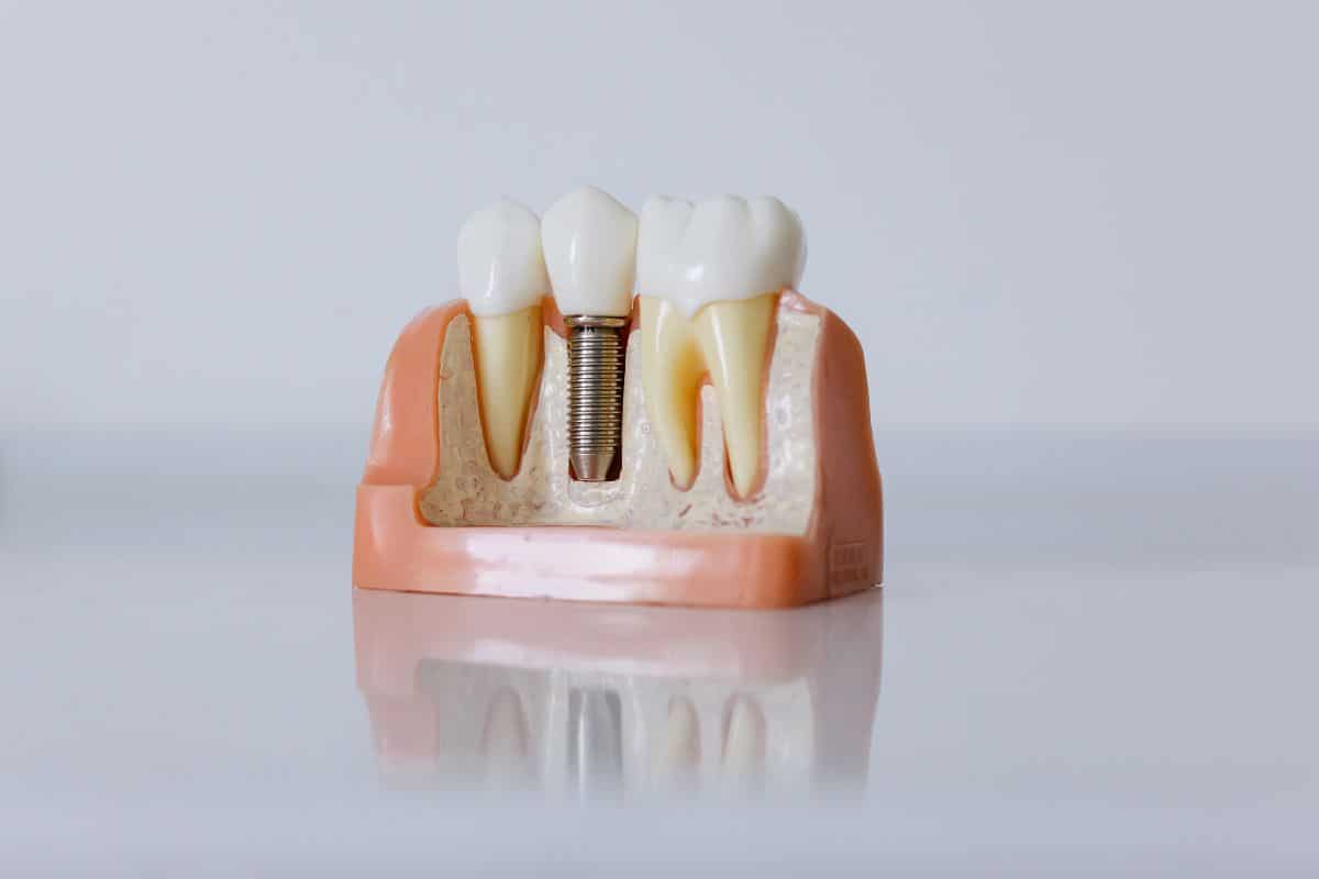 Dental Implants Tempe