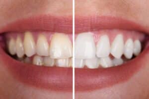 Teeth Whitening Tempe