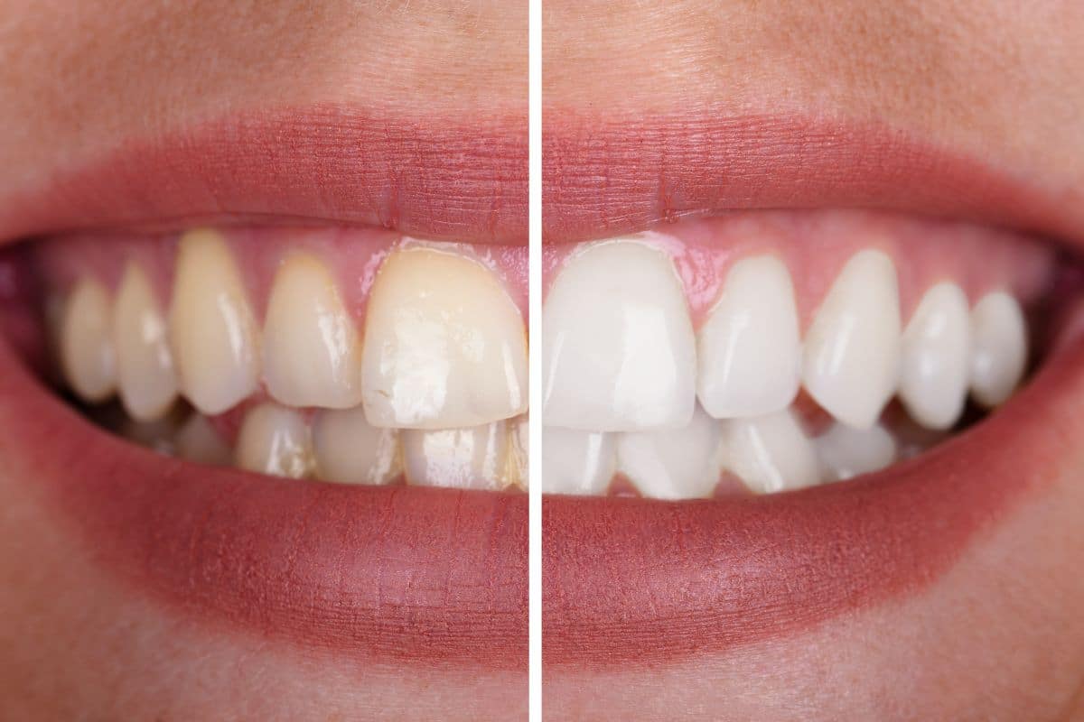 Teeth Whitening Tempe