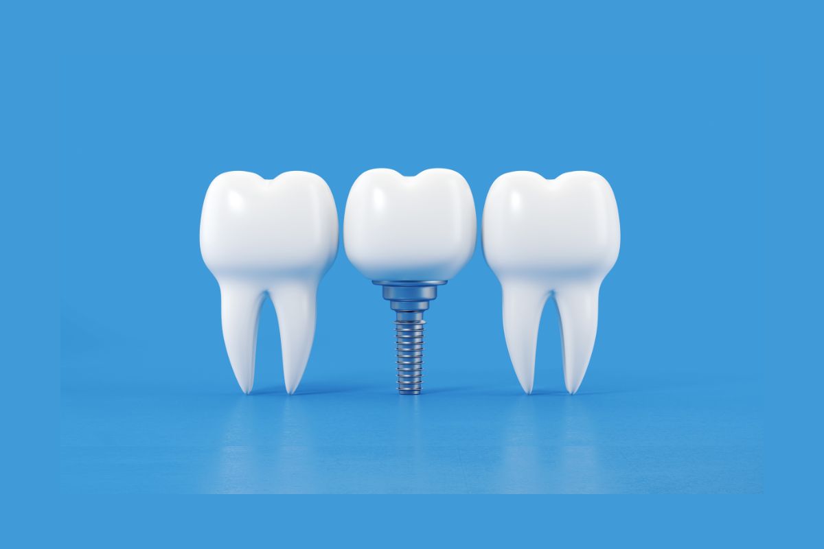 Dental Implants Tempe