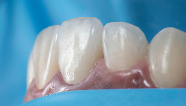 Dental veneers displayed on model teeth against blue background showing cosmetic dentistry results.