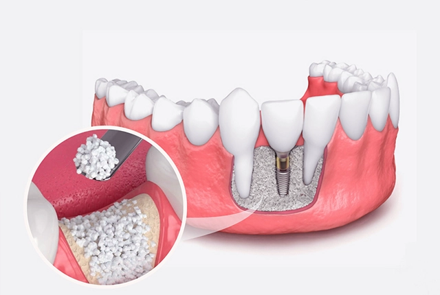 Dental implant diagram showing tooth structure, gum tissue, and implant components in cross-section