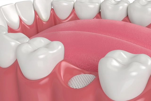 3D dental illustration showing tooth implant placement in gum with surrounding teeth
