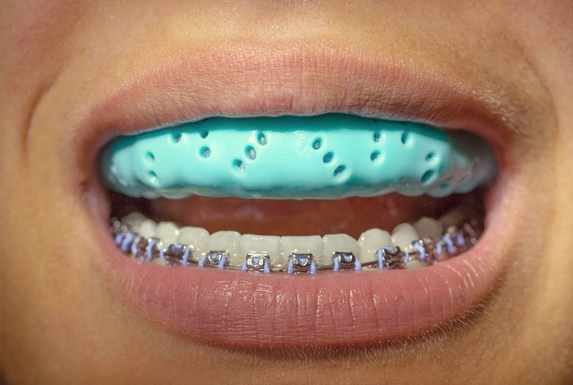 Close-up of open mouth showing dental braces and turquoise orthodontic appliance on upper teeth.