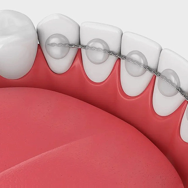 Clear braces on front teeth showing orthodontic treatment progression with pink gum tissue visible.