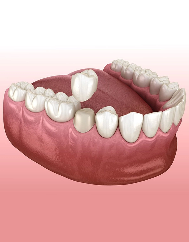 3D dental model showing full upper teeth and gum structure on pink background