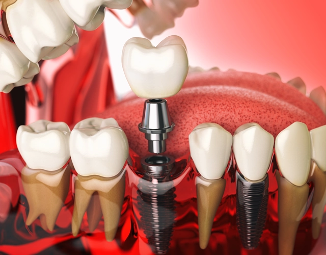 artificial dental implants module