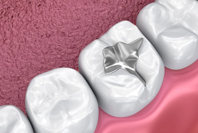 3D dental models showing tooth restoration with filling on pink background for dentistry practice.