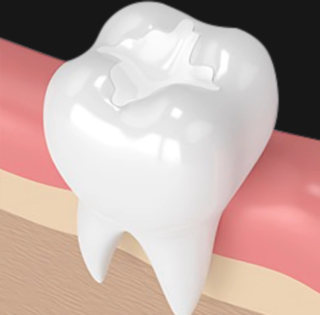 White tooth with dental crown displayed above pink gum tissue and bone model.