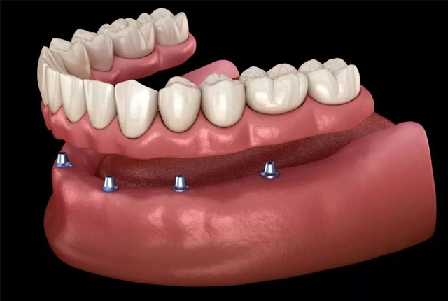 Dental implant model showing prosthetic teeth attached to implants in pink gum tissue.