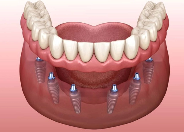Dental implant diagram showing prosthetic teeth anchored to jawbone with metal implant posts.
