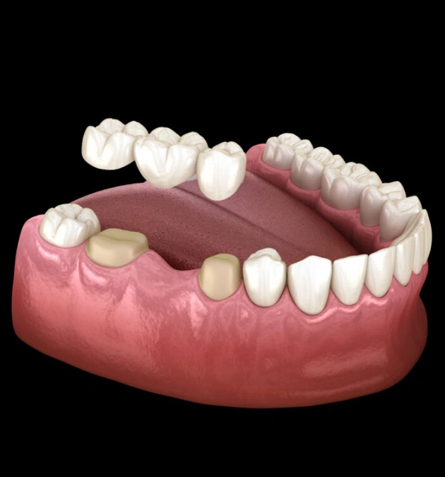 3D dental model showing implant crowns and natural teeth on pink gum base.