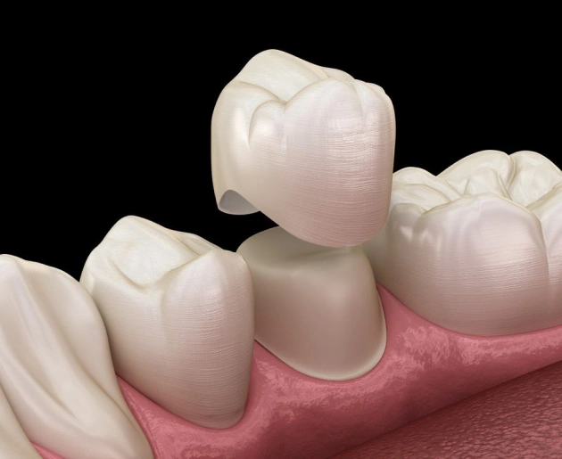 Dental crown placement illustration showing tooth preparation and ceramic crown restoration on gum model.