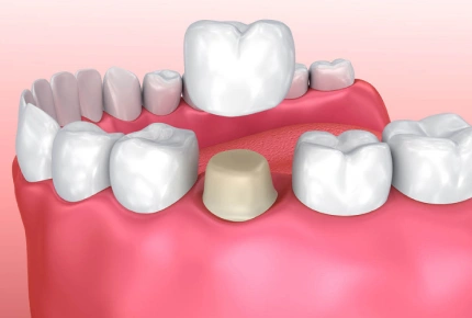 Dental crown procedure illustration showing tooth preparation and ceramic crown placement on gum model.