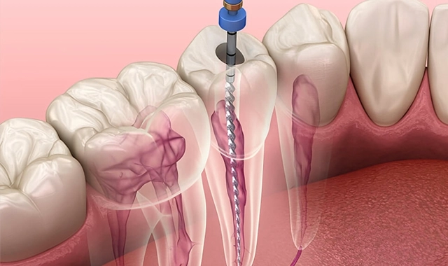 Dental implant surgical procedure showing tooth extraction, bone grafting, and implant placement in jawbone.