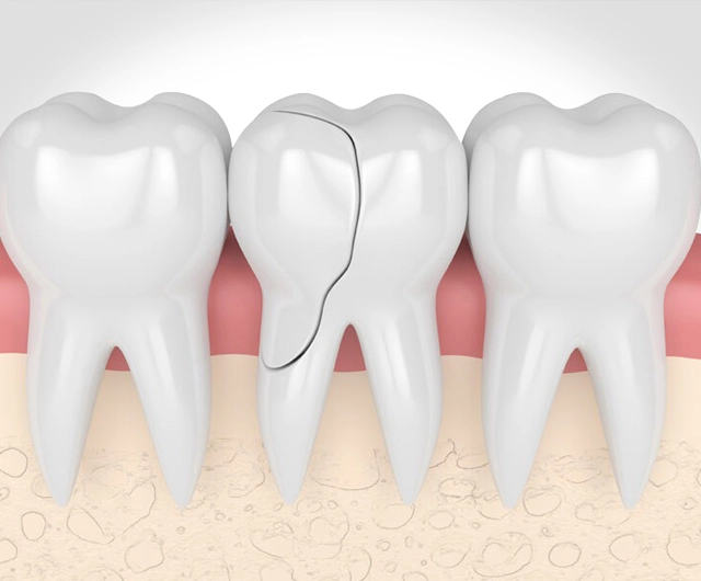 Three white teeth models on pink gums showing dental anatomy and tooth structure examination.