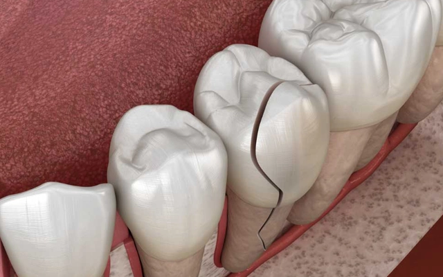 Dental model showing tooth cracks and fractures on molar teeth against red background.