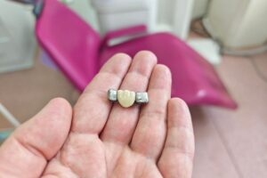 Dental Crowns in Tempe