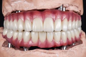 Dental Implants in Tempe