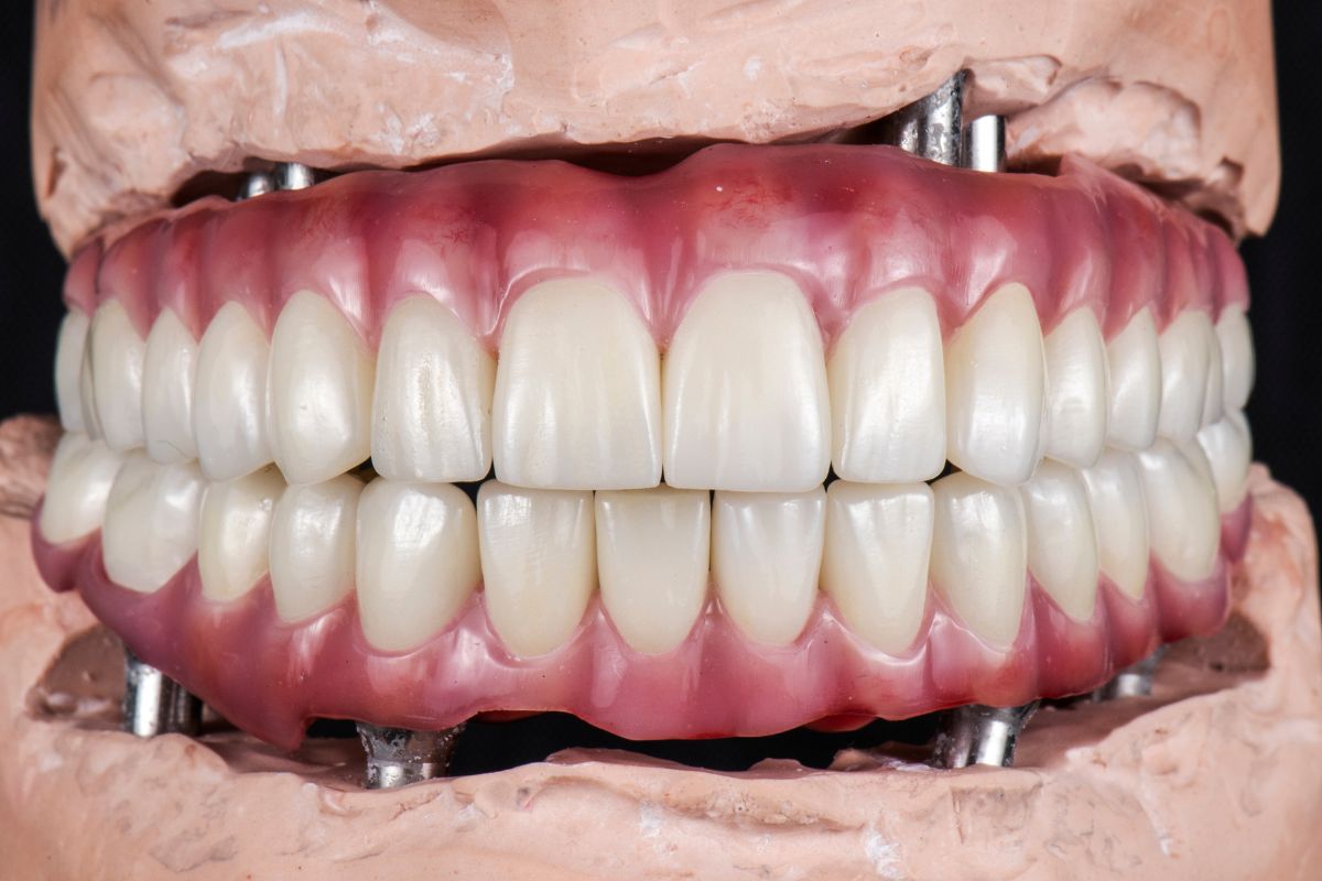 Dental Implants in Tempe