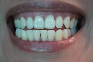 How To Get Rid Of Tetracycline Stains On Teeth