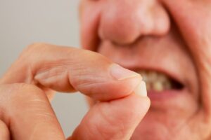 Treatment of Cracked Teeth