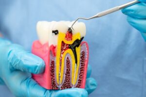 Root Canal Therapy