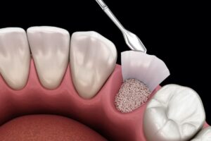 How Bone Grafting Can Benefit Your Oral Health