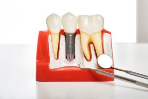 Artificial Dental Implants Showcase at Dental Office in Temp