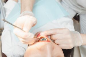 Handling Chipped or Broken Teeth Immediate Steps