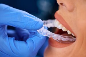 How Invisalign Can Transform Your Smile Without Braces In Tempe