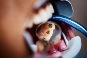 How Tempe Orthodontists Fix Crooked Teeth Faster Than You Think