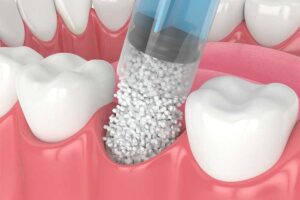 Complete Guide To Bone Grafting For Dental Implants In Tempe