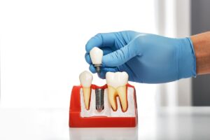 What Are The Best Solutions For A Missing Tooth A Guide For Tempe Families