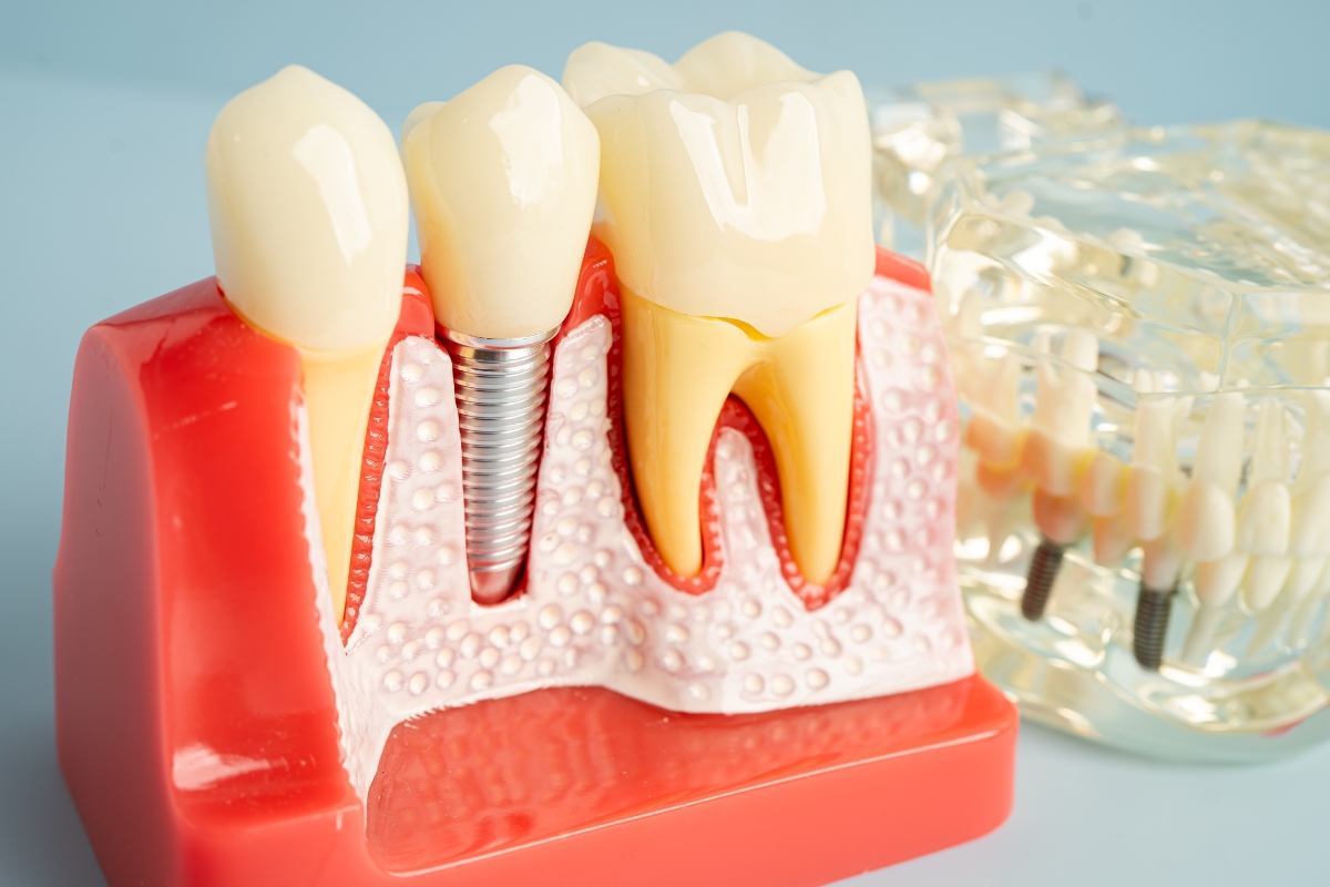 Dental Implant Recovery in Tempe Tips for Healing in a Dry Climate