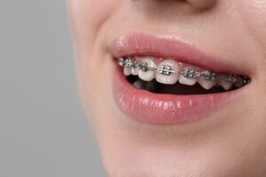 How to Choose the Best Orthodontist in Tempe