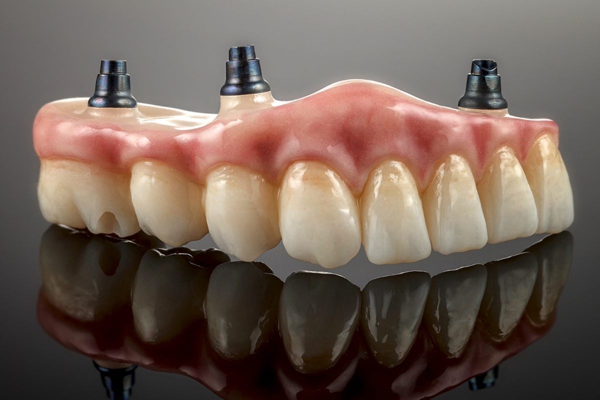 Dental Implants in Tempe