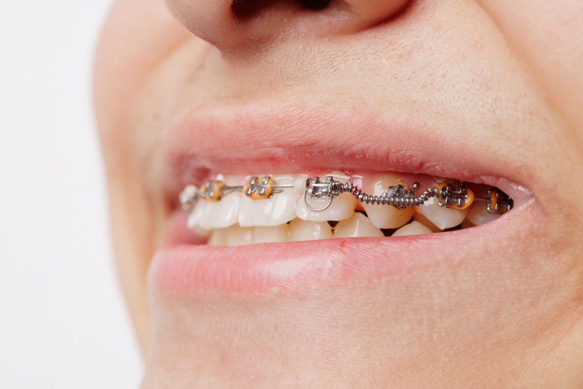 How Long Does Orthodontic Treatment Take